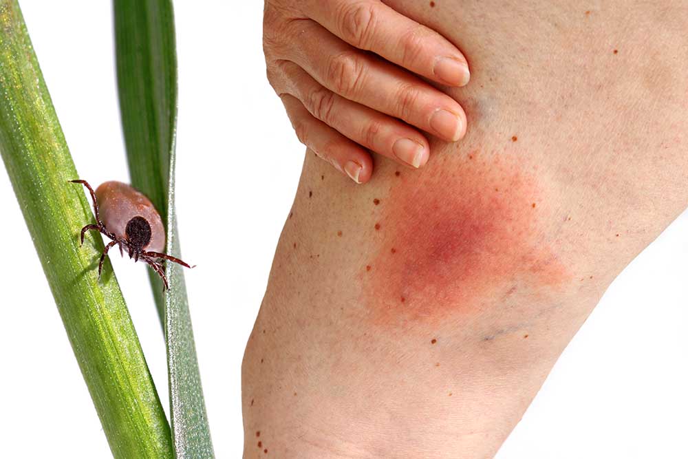 Unveiling Lyme Disease: Understanding the Risks and Implications